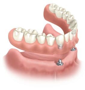 ایمپلنت دندان - اوردنچر متکی بر ایمپلنت 
